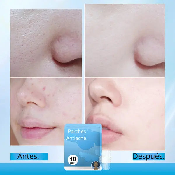 ADIOS PUNTOS NEGROS Y ESPINILLAS