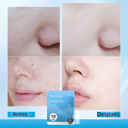 ADIOS PUNTOS NEGROS Y ESPINILLAS